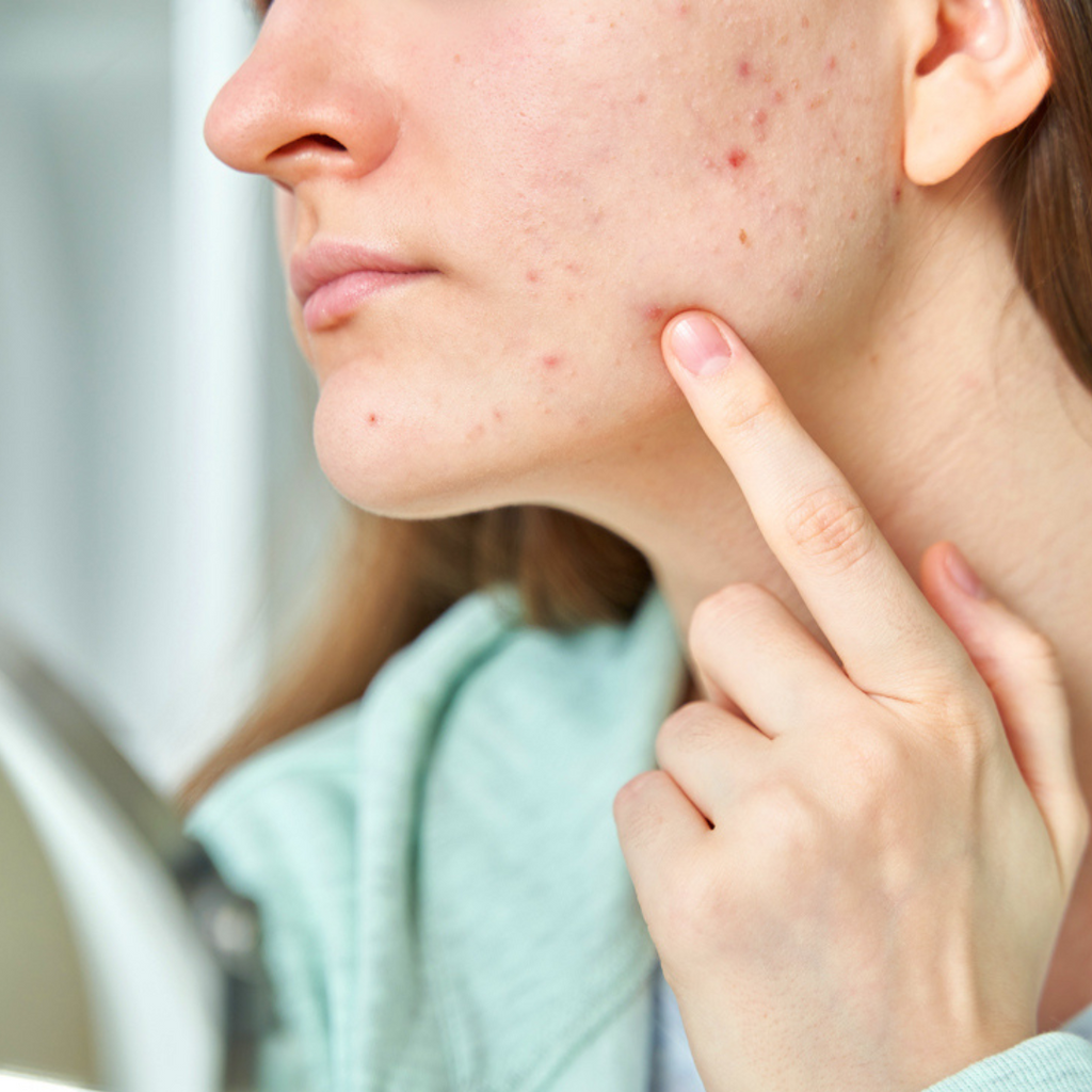 5 Effective Herbal Skin Treatments to Fight Acne, Eczema, and Other Skin Conditions